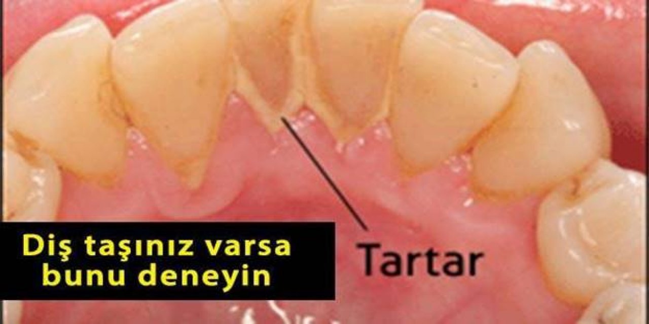Dişlerinizde Oluşan Taşları Bu basit tarifle evde kolaylıkla yok edebilirsiniz