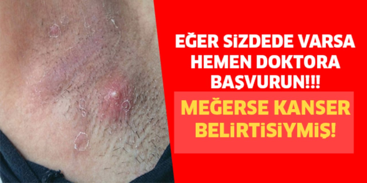 Kanserin En Sinsi Belirtisi Çıktı Çoğumuz Görmezden gelip önemsemiyoruz