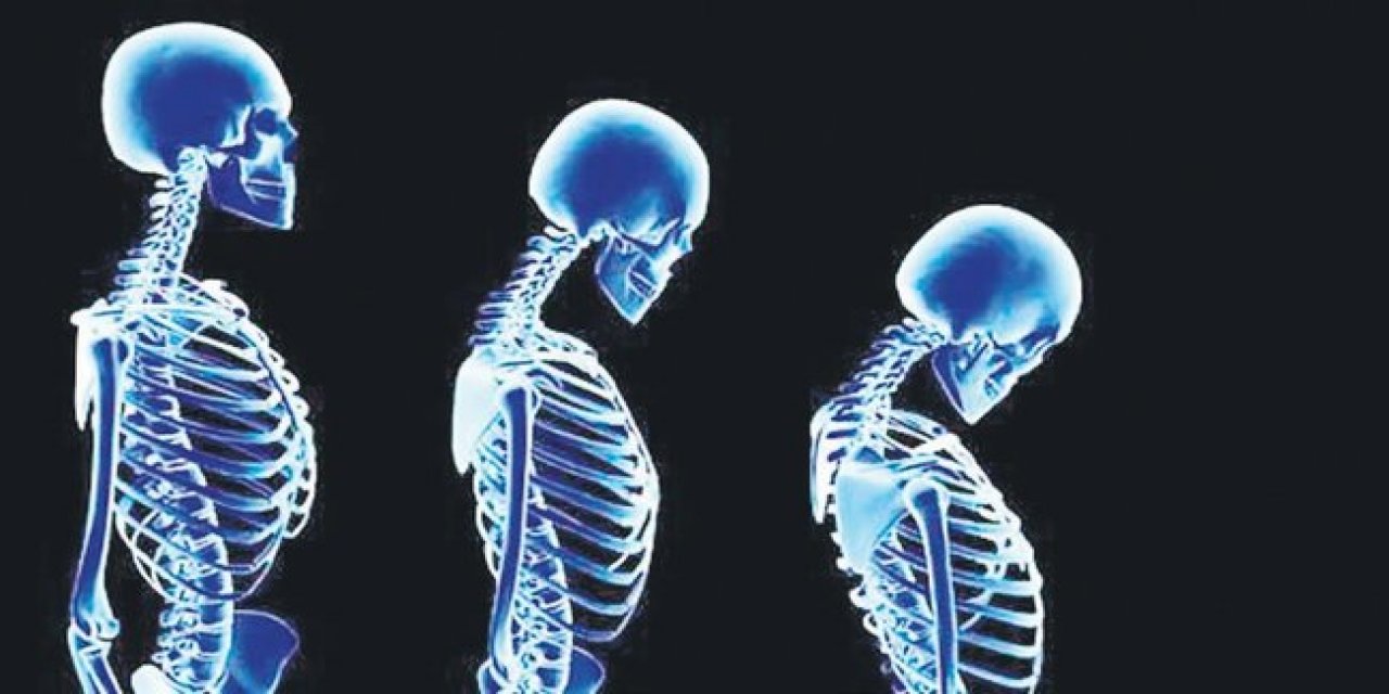 Kadınlarda Osteoporoz (Kemik Erimesi) Neden Olur