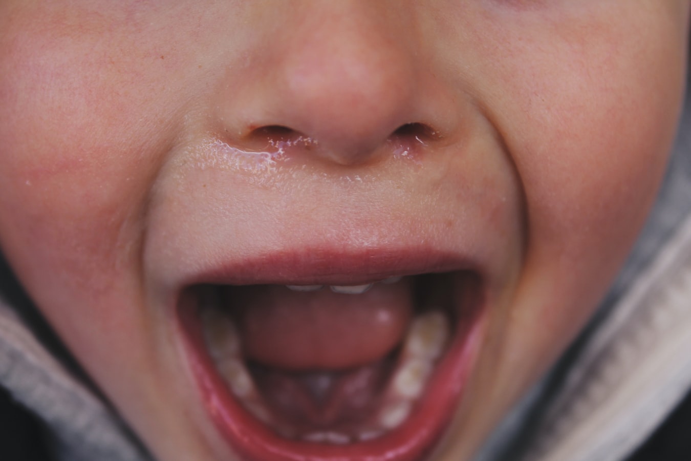 Çocuklarda ağız kokusu (Halitozis) neden olur?