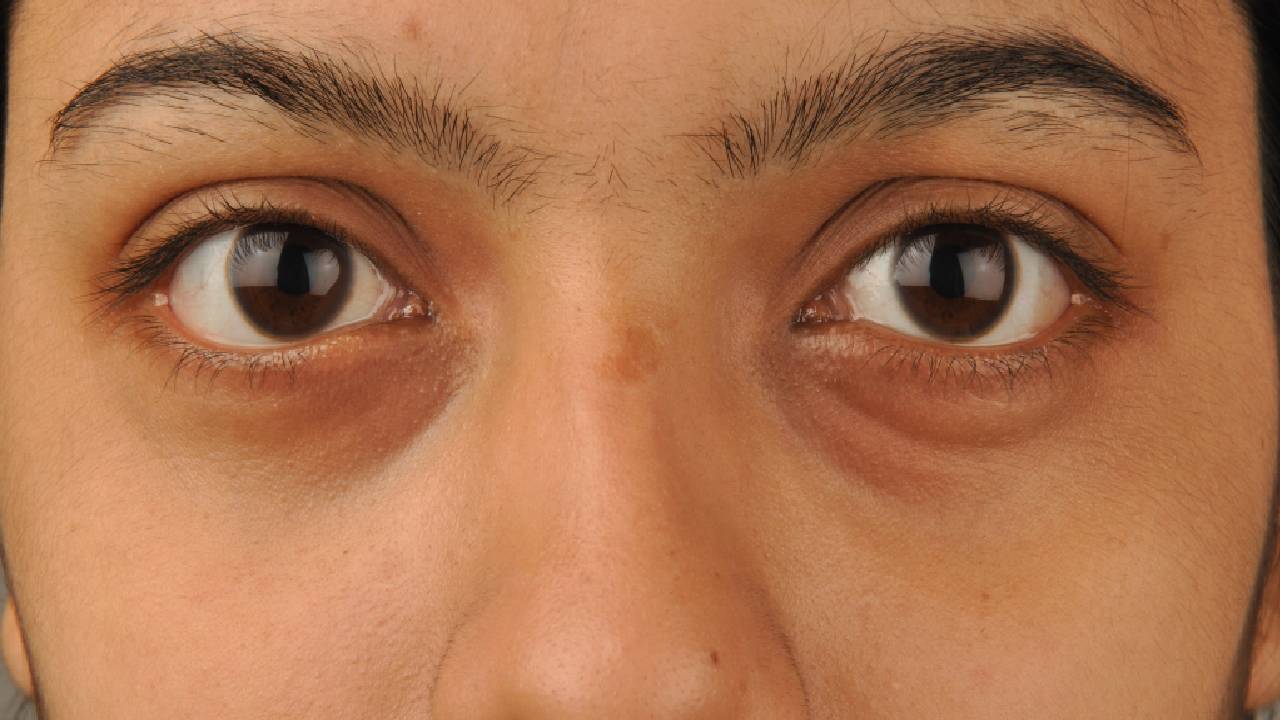 Baş Belası Göz Altı Morlukları Neden Oluşur? Göz Altı Morluklarınından Kurtulmak İçin Altın Değerinde Öneriler