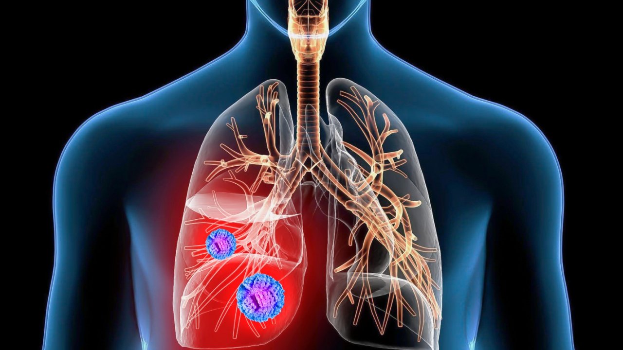 Akciğer kanserinde uygulanan tedavi yöntemleri