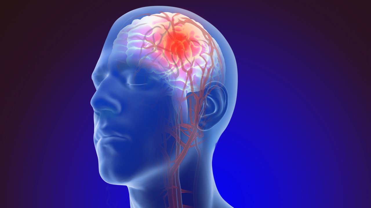 Beyin anevrizması nedir, belirtileri nelerdir, nasıl tedavi edilir?