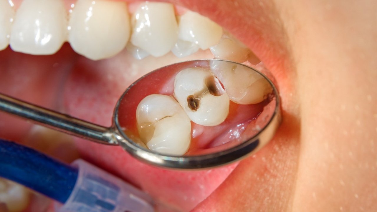 “Okul çağındaki çocukların yüzde 60 ila yüzde 90’ında diş çürüğü görülüyor”