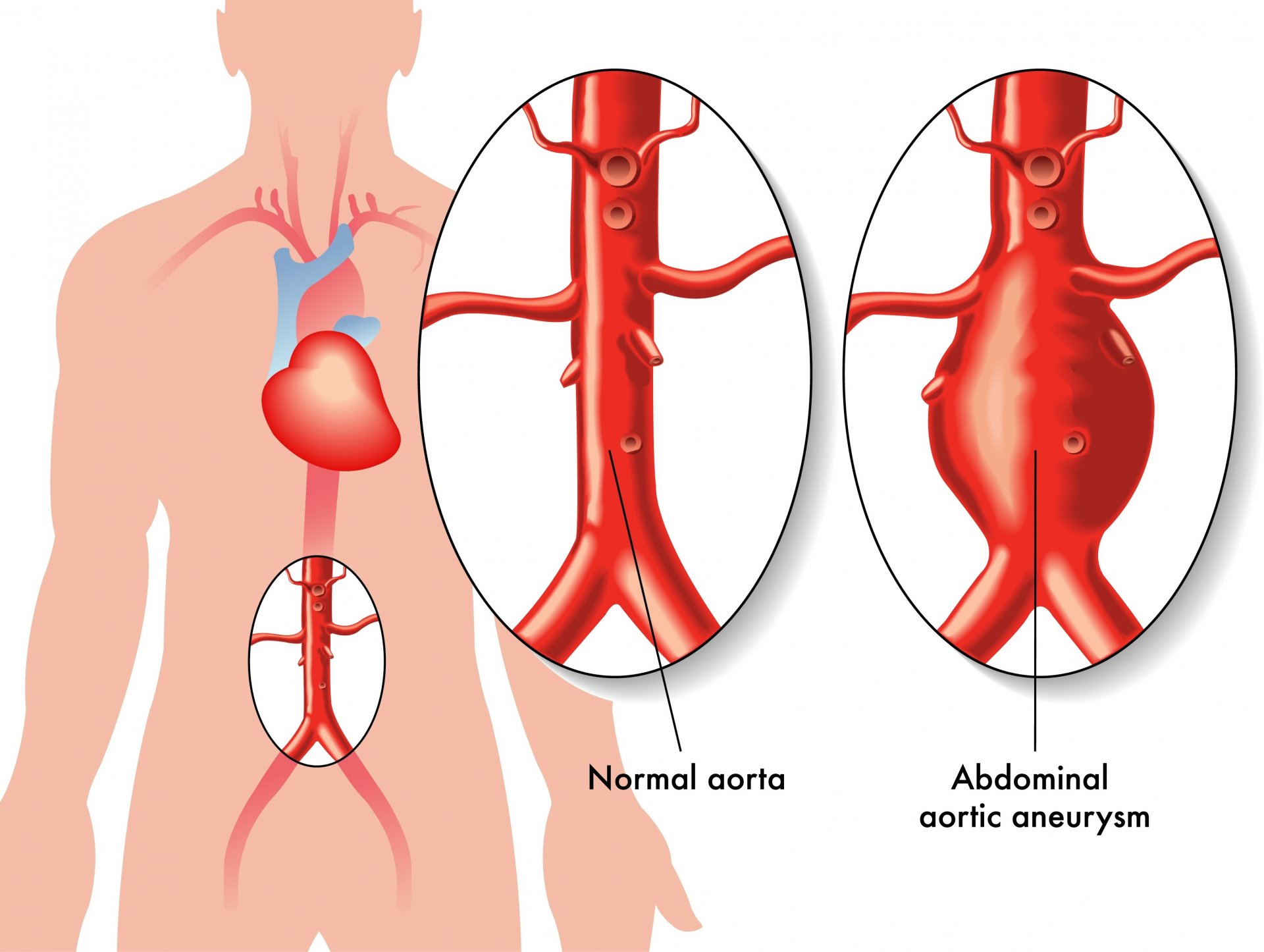 Aort Anevrizmaları Erken Tanı ve Tedavi İle Kontrol Altına Alınmalı